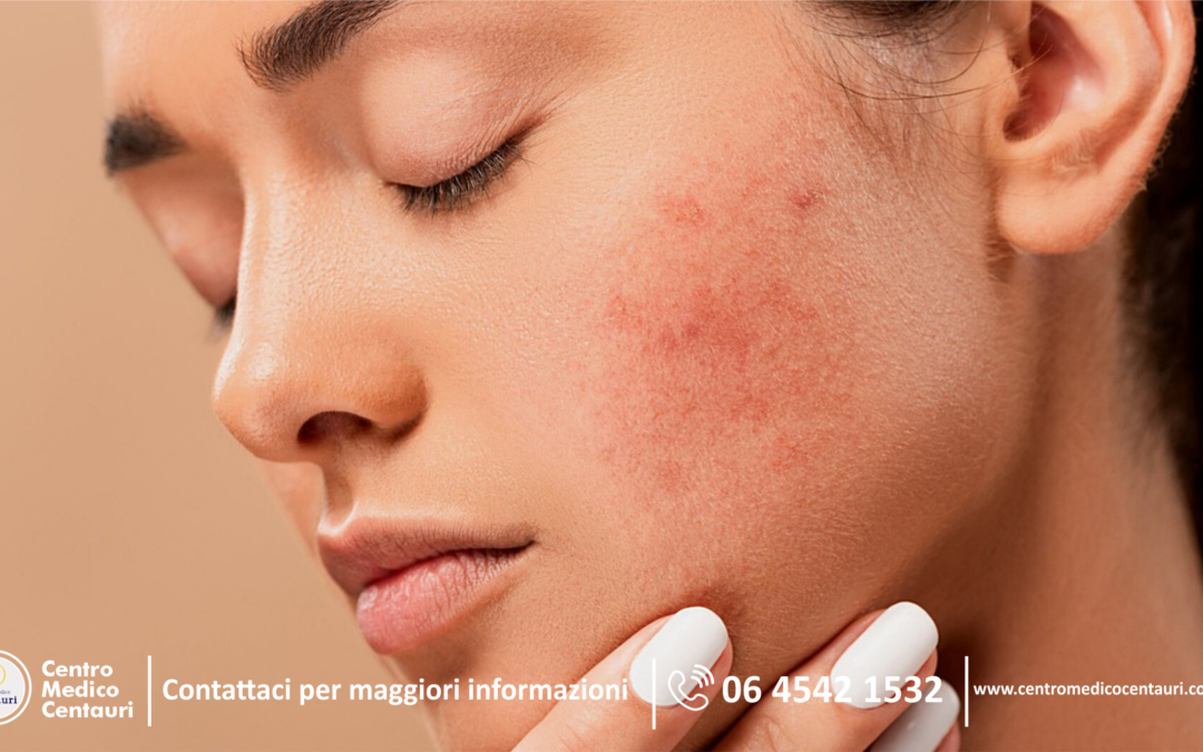 📣 𝘉𝘳𝘶𝘧𝘰𝘭𝘪 𝘴𝘰𝘵𝘵𝘰𝘱𝘦𝘭𝘭𝘦? 📣𝘐𝘭 𝘥𝘦𝘳𝘮𝘢𝘵𝘰𝘭𝘰𝘨𝘰  𝘤𝘪 𝘴𝘱𝘪𝘦𝘨𝘢 𝘤𝘰𝘮𝘦 𝘱𝘳𝘦𝘷𝘦𝘯𝘦𝘳𝘭𝘪 𝘦 𝘤𝘶𝘳𝘢𝘳𝘭𝘪. 𝘚𝘤𝘰𝘱𝘳𝘪 𝘥𝘪 𝘱𝘪𝘶̀ 👇